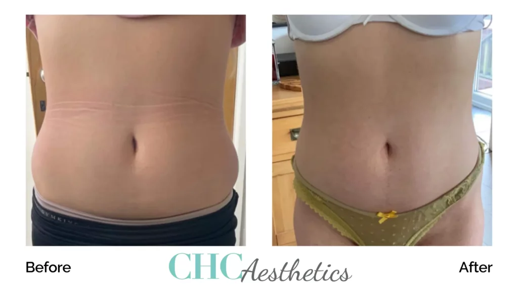 Cellulite Reduction