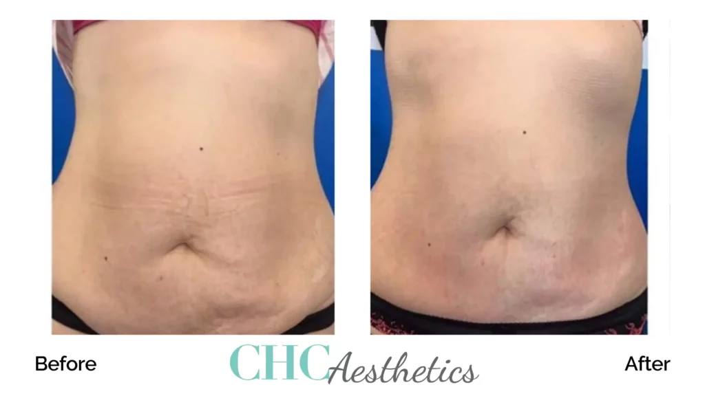 Cellulite Reduction