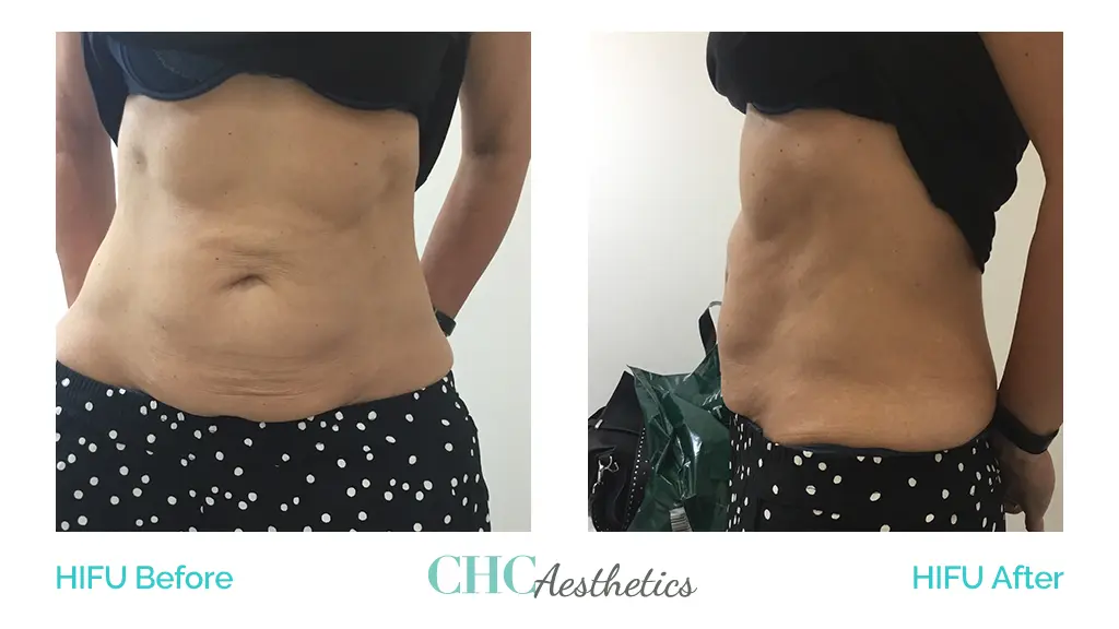 HIFU Body