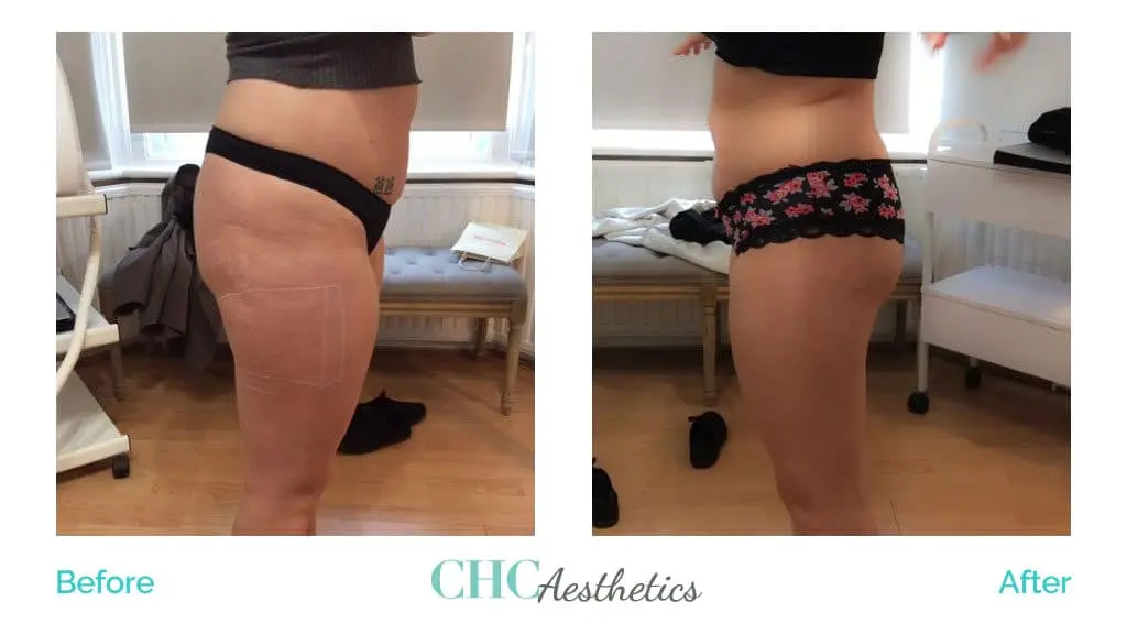 Cellulite Reduction Treatment Results