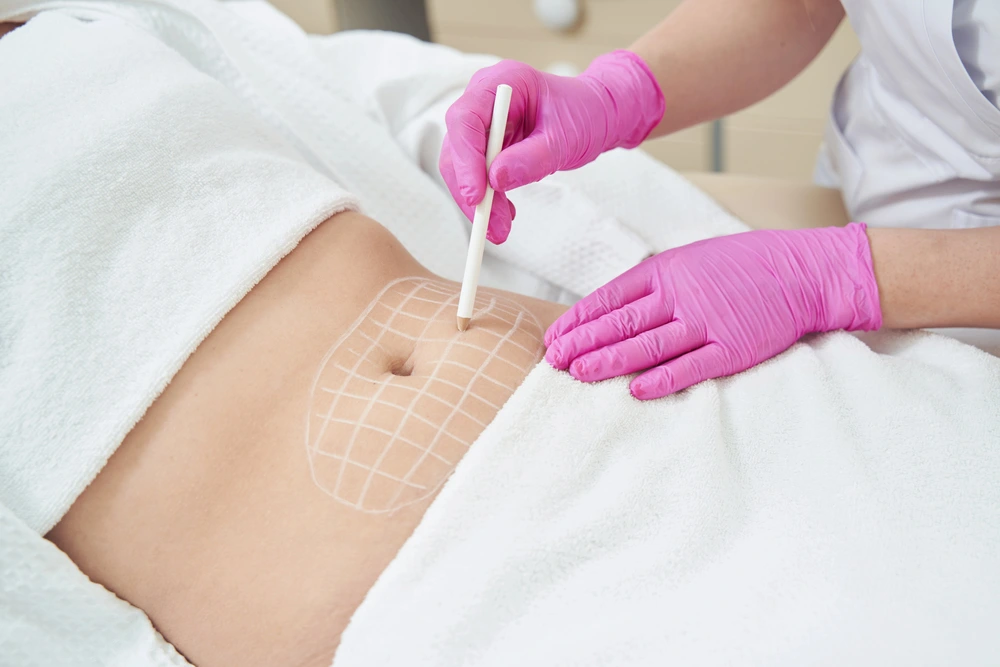 woman getting markings on stomach ready for fat reduction treatment