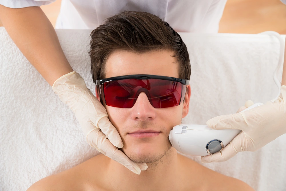 Laser Hair Removal on a Mans Beard